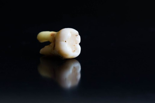 Tooth Extraction by OrangeCountySurgeons  